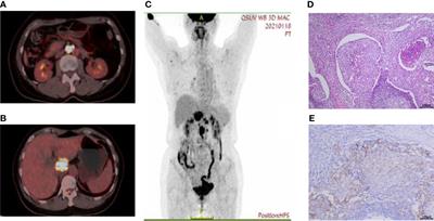 Immunochemotherapy achieved a complete response for metastatic adenocarcinoma of unknown primary based on gene expression profiling: a case report and review of the literature